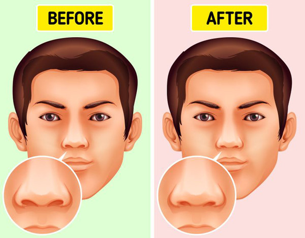 Phá nát khoang mũi. Ngoài việc tạo điều kiện đưa vi khuẩn đi sâu vào cơ thể, thói quen ngoáy mũi còn làm tăng nguy cơ hỏng khoang mũi. Kết quả nghiên cứu chỉ ra, người thường xuyên ngoáy mũi hay bị viêm, sưng mô mũi hơn. Thậm chí, thói quen xấu này có thể làm thu hẹp lỗ mũi.