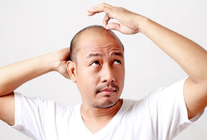 Ung thư tuyến tiền liệt. Theo một nghiên cứu, những người đàn ông hói đầu có khả năng bị ung thư tuyến tiền liệt cao hơn đàn ông bình thường. Khảo sát được tiến hành ở Tây Ban Nha với 30 đối tượng nam giới cho thấy, 34% những người đàn ông bị rụng tóc, hói đầu có tuyến tiền liệt kích thước lớn hơn (bệnh phình tuyến tiền liệt). Ảnh: Bottomlineinc.