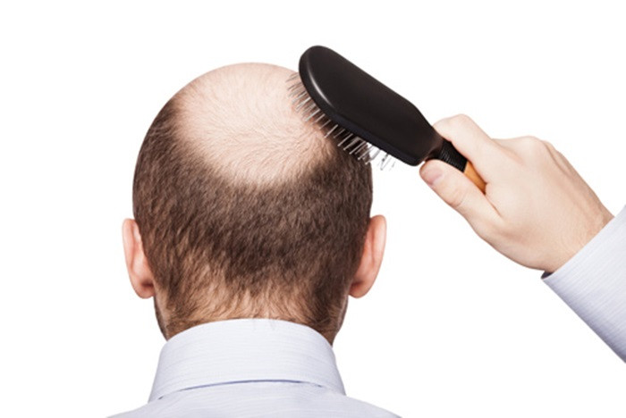 Rối loạn hệ miễn dịch. Chứng hói đầu cũng do một loại ban đỏ. Bệnh này khiến hệ thống miễn dịch mất khả năng nhận biết tác nhân lạ gây hại. Khi nhiễm lupus ban đỏ, hệ thống miễn dịch sẽ không giúp cơ thể chống lại sự xâm nhập của tác nhân lạ mà quay ra chống lại cơ thể bằng cách sinh ra các kháng thể kháng lại các tế bào của hầu hết các cơ quan như nang tóc nang lông làm cho nó không mọc được. Ảnh: Namkhoa.
