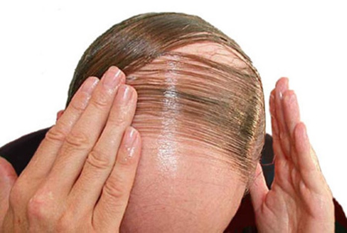 Khi hormone tuyến giáp tăng cao cũng khiến chu kỳ tăng trưởng tóc bị rối loạn khiến tóc yếu, mỏng và dễ gãy rụng. Ảnh: Hoidau.