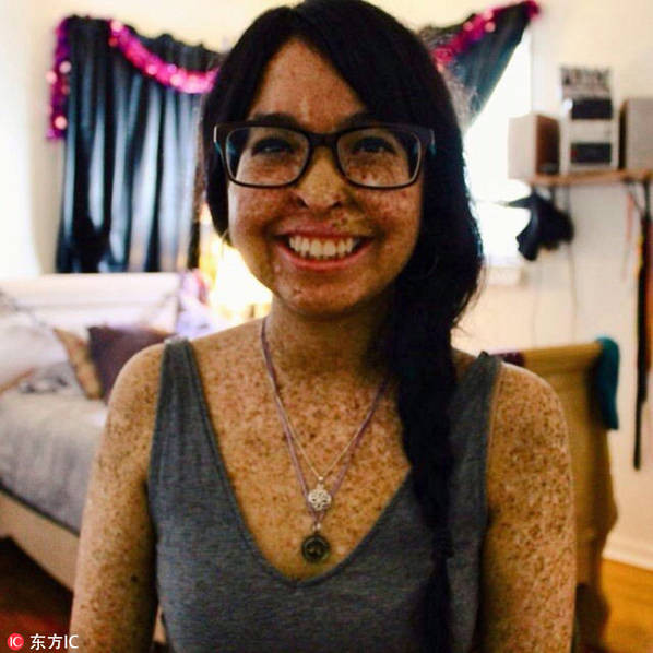 Cô Andrea Monroy, 23 tuổi, mắc phải một căn bệnh về da hiếm gặp, đó là cực kỳ nhạy cảm với ánh sáng mặt trời, tiếp xúc quá nhiều với ánh nắng có thể dẫn đến ung thư. Khi còn nhỏ, cơ thể Andrea đã có những tàn nhang bất thường. Lúc 5 tuổi, cô được chẩn đoán bệnh khô sắc tố da. Để bảo vệ làn da của Andrea, gia đình cô phải sử dụng cửa sổ màu và cho cô con gái học trong nhà. Andrea chỉ có thể đi ra ngoài vào ban đêm.