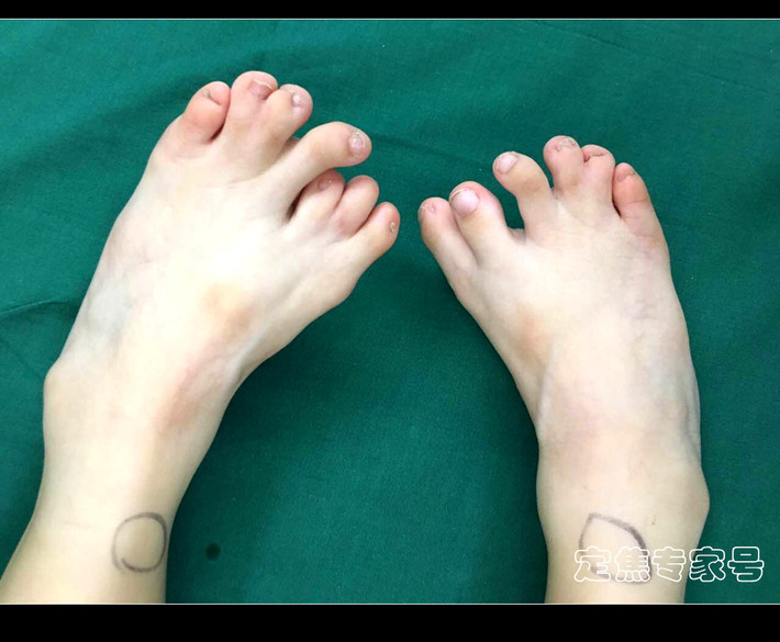 Hình ảnh ghi lại chân một bé gái Trung Quốc 4 tuổi bị dị tật bẩm sinh có 13 ngón, chân trái của bé có 7 ngón, chân phải 6 ngón. Kể từ khi được sinh ra, cha mẹ bé đã sống trong sự đau khổ vì lo lắng dị tật sẽ tiếp tục biến chứng, cùng với đó là sự nhạo báng của miệng lưỡi người đời.