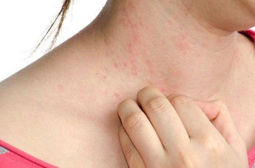 Sau khi thăm khám, bác sĩ kết luận chị bị viêm da do mồ hôi ra nhiều mà không vệ sinh sạch sẽ. Em bé thì bị viêm phế quản nhẹ. Bác sĩ còn “giáo huấn” cho hai bà một bài về cách chăm sóc sản phụ và trẻ sơ sinh. May mà chị được nhập viện sớm nên hai mẹ con không có vấn đề gì nguy hiểm. Cũng nhờ thế mà từ hôm đó chị mới được tắm gội và ăn uống thoải mái.