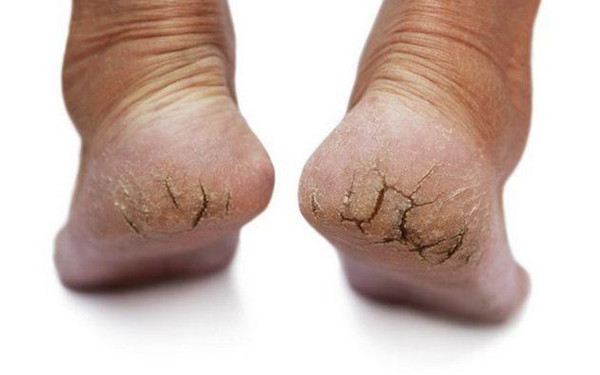 Để đánh giá liệu gót chân nứt nẻ thông thường hay nhiễm nấm, cách tốt nhất là đến bệnh viện kiểm tra. Kết quả soi nấm sẽ chỉ ra bạn nhiễm loại nấm nào để điều trị hiệu quả. (Ảnh minh họa)