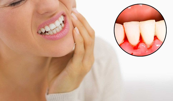Chảy máu nướu không rõ nguyên nhân: Chảy máu nướu có thể bắt nguồn do nóng trong hoặc nướu nhạy cảm. Tình trạng này sẽ sớm hết nếu bạn áp dụng chế độ ăn uống phù hợp.