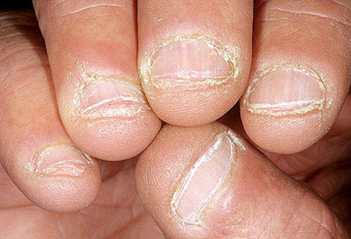 Bong tróc móng tay. Cơ thể thiếu vitamin E sẽ gây ra hiện tượng gãy móng tay hoặc bong tróc móng tay. Nên bổ sung củ cải, rau cải xanh, bơ, hạt dẻ, đu đủ, khoai môn, ớt chuông đỏ... để tăng cường vitamin E cho cơ thể.