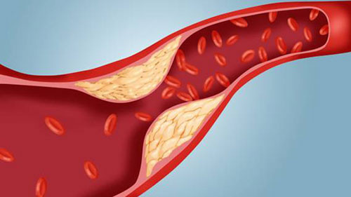 Khi cholesterol cao, chúng sẽ tích tụ trong các lớp lót bên trong của động mạch, tạo thành các mảng bám. Qua thời gian, các mảng bám tích tụ làm hẹp dòng chảy động mạch và hạn chế máu đi qua. Những người có cholesterol cao, triglycerides cao, lượng cholesterol tốt thấp và cholesterol xấu cao, lipoprotein bất thường có thể phải đối mặt với những cơn đau tim và đột quỵ.