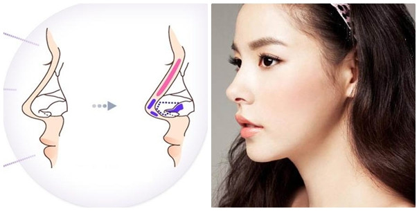 Bên cạnh đó, bạn cũng nên tuân thủ các hướng dẫn của bác sĩ sau phẫu thuật để tránh làm tăng nguy cơ biến chứng. Ảnh: miraclevn.