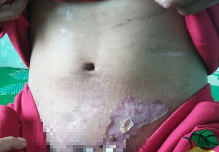 Lấy kìm cắt kẽm để cắt tai em. Cây gỗ bà đóng đinh 5 vào rồi đánh liên tiếp vào người, vào chỗ kín. Răng em bà ấy lấy búa đánh chưa gãy thì lấy kìm ra nhổ mất 3 cái. Vết thương trên mặt em là do bà Na "chị em kết nghĩa" của bà Nga cắt, rạch", Y Nhiêu kể lại với phóng viên. (Ảnh: saostar.vn)