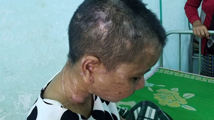 Theo lời kể của Y Nhiêu, trước đó cô vẫn làm việc bình thường. Nhưng khoảng 2 tháng trở lại đây, cô bắt đầu bị bà chủ đánh đập bằng nhiều ngón đòn kinh khủng. Thường là sau khi bà này dùng ma túy, đổ cho Y Nhiêu tội trộm tiền để lấy cớ đánh đập, hành hạ cô. (Ảnh: Người Lao Động)