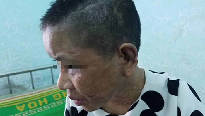 Tiếp cận với chị Y Nhiêu, báo Người Lao Động phản ánh, từ những ngày đầu mới bị tra tấn, Y Nhiêu đã nghĩ đến chuyện bỏ trốn nhưng bị bà chủ dọa giết cả người thân nên cô sợ không dám. Tuy nhiên, đến lúc bị bà chủ dọa cắt lưỡi thì vô cùng hoảng sợ, liều bỏ trốn trong lúc đi đổ than. (Ảnh: Người Lao Động)