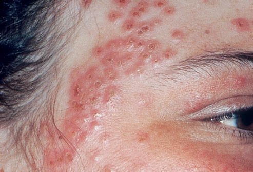 Trị Eczema: Dùng tinh dầu gỗ tuyết tùng hằng ngày, để tăng tính hiệu quả lên cao hơn thì chúng ta có thể dùng thêm dầu, kem dưỡng, để bôi trực tiếp lên khu vực đang bị viêm nhiễm, hoặc cho 5 giọt tinh chất tuyết tùng vào nước tắm và tắm hàng ngày. Ảnh: bacsiviemdacodia.com.