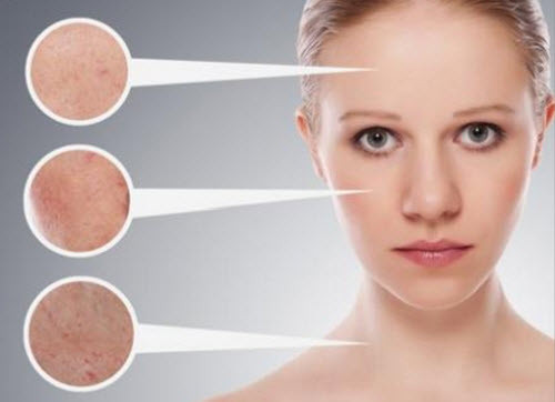 Ức chế tăng tiết nhờn, se nhỏ lỗ chân lông. Ảnh: Cachtrangda.com.