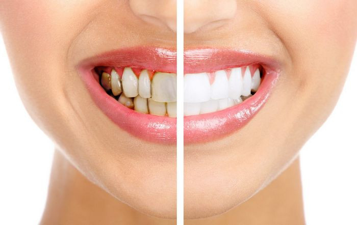 Làm trắng răng. Những người có hàm răng xỉn màu, khi tiếp xúc với gỗ sưa 100 tuổi trở lên răng có thể trắng trở lại. Ảnh: Nhakhoavietuc.