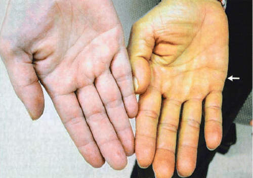 Nếu bàn tay có màu cam đỏ, điều này thể hiện bạn đã mắc phải tình trạng Lycopenemia khi ăn quá nhiều thực phẩm có màu đỏ như củ dền, cà chua, các loại trái cây màu đỏ. Ảnh: benhvienbenhgan.vn.