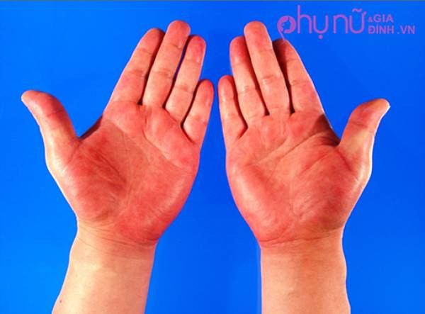 Bàn tay có màu đỏ là một dấu hiệu của các rối loạn gan, viêm khớp dạng thấp và các rối loạn tuyến giáp. Ảnh: 2sao.vn.