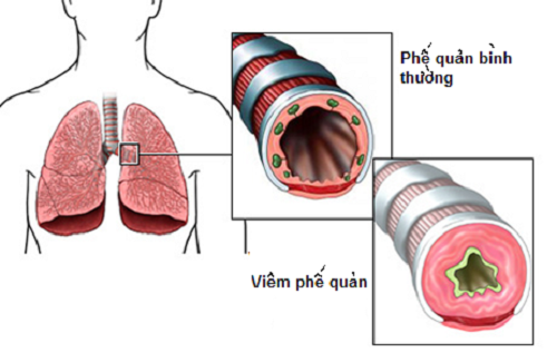 Thời tiết thay đổi đột ngột là thời điểm thuận lợi cho bệnh viêm phế quản phát triển. Lúc này, bạn hãy nấu những món cháo trị bệnh viêm phế quản sau đây, vừa ấm bụng mà giảm ho rất tốt. Ảnh: Bvthucuc.
