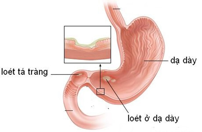 Loét dạ dày tá tràng. Dùng 100g lạc nhân nấu cùng thịt lợn nạc hoặc trứng gà ăn mỗi buổi sáng trước khi ăn sáng nửa giờ đồng hồ. Dùng liên tục trong 1-2 tuần, cơn đau tá tràng sẽ dịu. Ảnh: Gastimun.