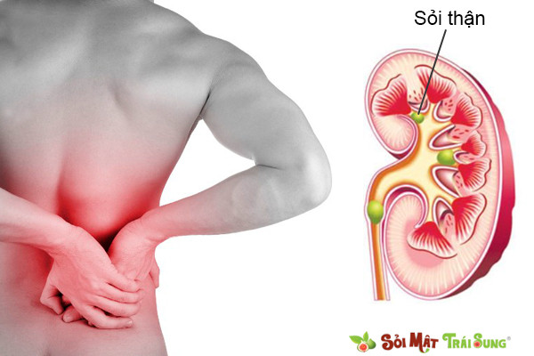 8. Trị bệnh sỏi thận từ hạt đười ươi và chuối hột: Rang chín chuối hột, hạt đười ươi. Sau đó xay thành bột. Trộn 2 nguyên liệu đó theo tỉ lệ 4 chuối hột : 1 đười ươi. Sáng uống 1 muỗng canh. Tối có thể sau 21h uống 2 muỗng canh. Ảnh: soimattraisung.vn. (Thông tin trong bài chỉ mang tính chất tham khảo, trước khi sử dụng bài thuốc, vui lòng hỏi ý kiến bác sĩ).