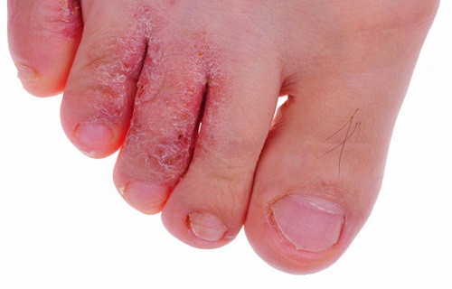 Nấm ăn chân, ghẻ: Lấy lá đào tươi giã nát, đắp. Ảnh: benhmedaymanngua.com.