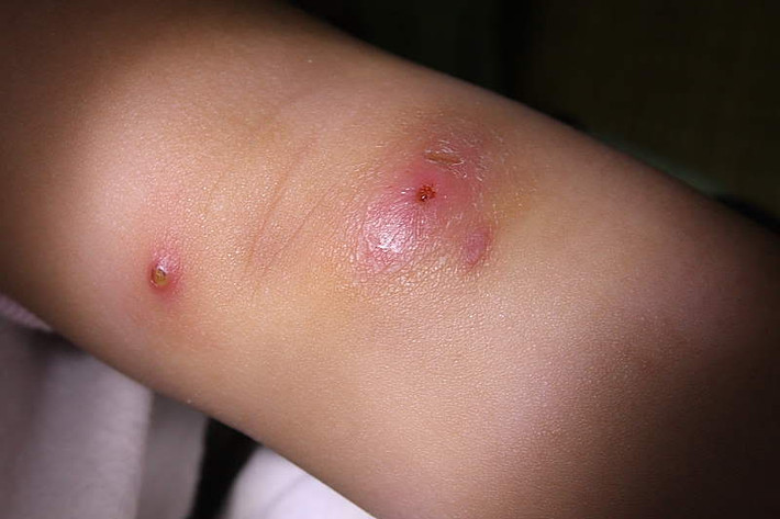 5. Chữa sưng tấy, mụn nhọt, lở loét, dị ứng: Lá dâu da xoan thường dùng giã nát trộn giấm bôi vào vết lở loét, sưng tấy giúp thuyên giảm. Ảnh: dieutrimundrhue.com.