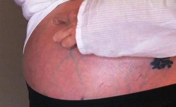 Chữa xơ gan cổ trướng. Dùng bồ hóng bếp đã giã nhỏ, rây mịn và men rượu (tỷ lệ 3:1), thêm vào một ít mủ xương rồng để có hỗn hợp nhão vắt thành viên có kích thước bằng hạt ngô. Ngày dùng 3 viên cho vào chuối chín rồi nuốt. Khi đi ngoài thấy phân trắng như nước gạo là khỏi. Ảnh: Benhvienthucuc.