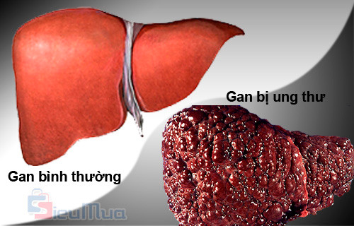 Ung thư gan: Đại hoàng giá trùng hoàn (một loại thuốc hoàn trong thành phần có gián đất) uống mỗi ngày 2 lần, mỗi lần 4,5g với nước ấm. Ảnh: soha.vn.