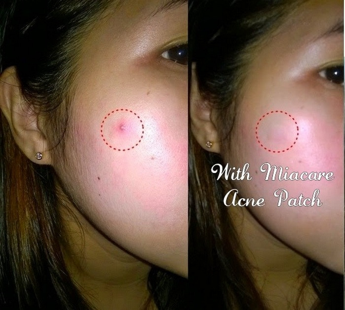 Miếng vá mụn hiện nay được cải tiến nhiều hơn nhờ hợp chất trị mụn kinh điển là lưu huỳnh và axit salicylic có trong nó. Ảnh: Beautybella.