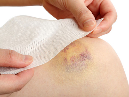 Trị bầm tím: Dùng quả bần nghiền nát thành thuốc dán hay bột nhảo đắp lên hoặc trộn với muối, đắp lên những vết cắt và những vết bầm (ứ máu) tím. Ảnh: doisongphapluat.com.