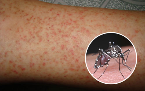7. Lá sen khô chữa bệnh sốt xuất huyết: Chuẩn bị lá sen khô 30g, ngó sen hoặc cỏ nhọ nồi 40g, rau má 30g, hạt mã đề 20g. Cho hết các nguyên liệu trên vào ấm, thêm nước sắc thành thuốc. Ngày uống một thang như trên. Nếu xuất huyết nặng hơn có thể tăng lượng lá sen lên 50 – 60g. Ảnh: Omron.com.vn.