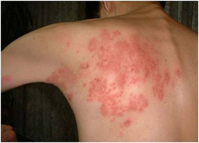Chàm Eczema là một loại bệnh dị ứng. Nó biểu hiện trên da là những vùng đỏ ửng, ngứa rát, nặng thì bong tróc vảy. Bệnh không nguy hiểm tính mạng nhưng lại gây bất tiện trong sinh hoạt. Người bệnh có thể chữa bệnh chàm Eczema từ củ quả sau. Ảnh: Benhvirus.