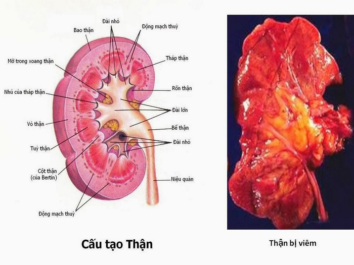 Chữa viêm thận: 60g quả dứa, rễ cỏ tranh tươi 30g, sắc uống thay nước hàng ngày để chữa bệnh này. Ảnh: Soithan.