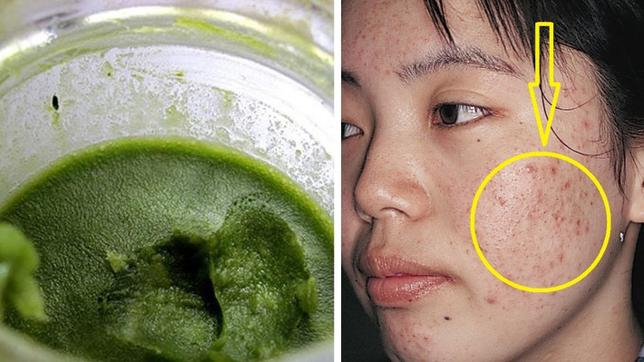 Dùng lá ổi trị mụn đầu đen: Dùng lá ổi giã nhuyễn rồi pha chút nước ấm, dùng dung dịch này rửa mặt hàng ngày, chà xát nhẹ vào những nơi có mụn sẽ giúp loại bỏ mụn nhanh chóng. Ảnh: youtube.com.