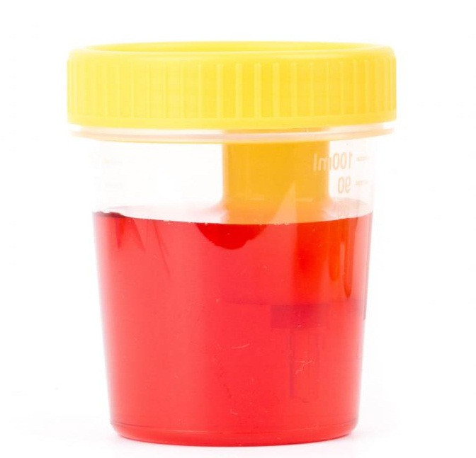 4. Tiểu ra máu, chảy máu cam: Giã nát 1kg hẹ, vắt lấy nước, cho nửa ký sinh địa xắt nhỏ vào nước này ngâm, rồi phơi ngoài nắng to cho tới khi sinh địa chuyển qua màu đen, nước hẹ khô đi thì đem vào nhà, giã nhuyễn bằng cối, rồi se lại thành viên to bằng hạt ngô. Ngày uống 2 lần vào sáng và tối, mỗi lần 2 viên. Dùng với canh củ cải trắng hiệu quả rõ rệt. Ảnh: namkhoahanoi.vn.