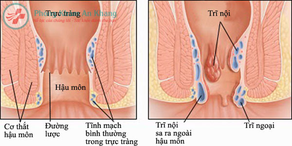 1. Chữa trĩ: Ốc đồng sống 1 con, băng phiến. Gỡ yếm ốc ra, rồi đặt băng phiến vào miệng ốc. Một lúc thì miệng ốc tiết nước ra lấy nước đó bôi vào trĩ. Ảnh: phongkhamankhang.vn.