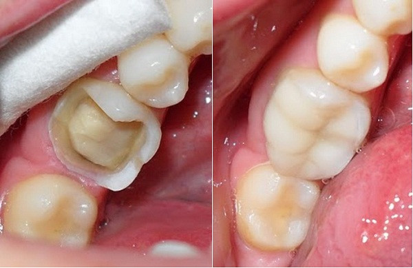 Trám răng: Lấy dịch đỏ chảy ra từ vỏ cây đem sấy khô được một chất nhựa. Nhựa cây này cũng có thể dùng để nhuộm răng. Ảnh: Siêu Thị Cây Xanh.