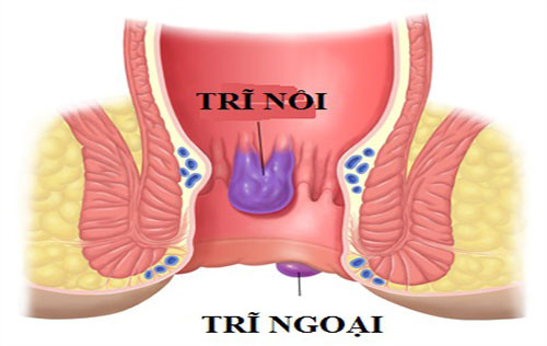 3. Hỗ trợ chữa trĩ (giai đoạn 1): Lá phèn đen 1 nắm, lá trắc bách diệp 1 nắm, lá huyết dụ 5 lá. Tất cả rửa sạch, thái nhỏ, sao vàng hạ thổ. Cho vào ấm, đổ 800ml nước, sắc đặc còn 200ml nước. Uống ngày 150ml, còn lại đổ thêm nước đun kỹ dùng để rửa ngâm trĩ ngày 1 – 2 lần. Mỗi liệu trình từ 5-10 ngày. Ảnh: m.dakhoa.phongkhamthekymoi.com.