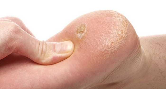 Chữa mụn cóc. Dùng vỏ quả chuối xoa lên chỗ bề mặt của mụn sẽ khiến mụn mềm và từng chút từng chút tróc ra cho đến khi hết. Cách này rất hữu hiệu cho các vùng da nhạy cảm như đầu, da mặt. Dùng vỏ chuối xoa nhiều lần và lấy tay vê nhẹ sẽ khiến mụn hết mà lại không bị tái phát. Ảnh: Alobacsy.