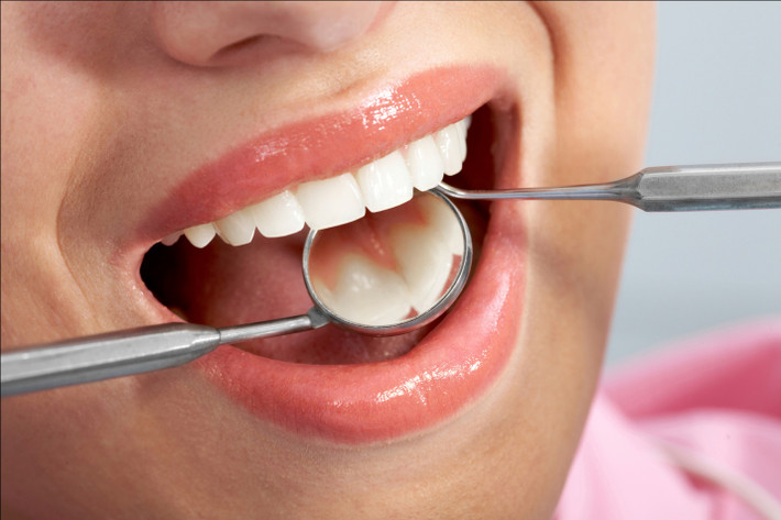 7. Chữa sâu răng: Dùng cành liễu nấu cao xỉa. Ảnh: koreadental.vn.(Thông tin trong bài chỉ mang tính tham khảo, trước khi sử dụng bài thuốc, bạn vui lòng hỏi ý kiến bác sĩ).
