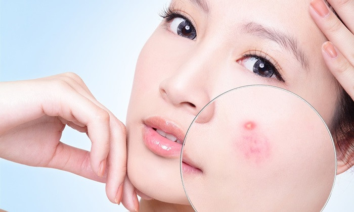 Trị mụn. Dùng gai bồ kết, quả bồ hòn đốt thành than rồi tán thành bột mịn, thêm một ít bồ hóng bếp và nhựa thông phết vào tờ giấy bản làm thanh cao và đắp lên chỗ mụn. Ảnh: Wru.