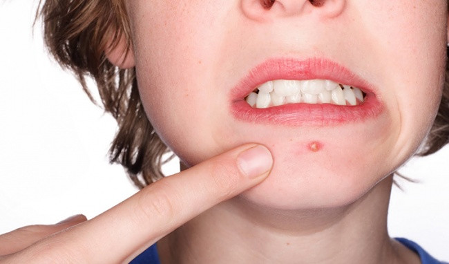 5. Chữa đinh râu, vết tụ máu bầm tím: Thịt nhái phối hợp với lá mua, lá cà pháo, giã nhỏ thêm ít nước vo gạo, gói vào băng gạc, nướng đắp vào chỗ đau. Ảnh: suckhoedoisong.vn.
