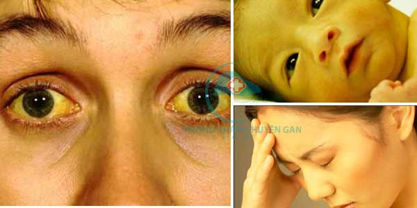 3. Chữa bệnh vàng da: Nhái 1 con, làm sạch, băm nhỏ, trộn với phèn đen 12g, rồi cho vào một cái mề gà trống, nấu chín nhừ. Để nguội bỏ nhái và phèn đen, ăn mề gà. Ảnh: 12kimma.com.