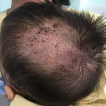 Trị chốc lở đầu ở trẻ em: Dùng vỏ thân cây sung còn tươi, sài đất tươi mỗi thứ 50g, lá trầu không 30g, bồ kết 20g sắc nước gội. Ngày một lần. Ảnh: AloBacsi.