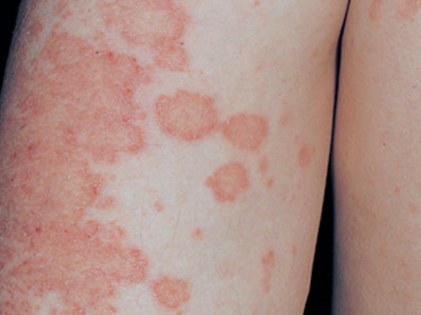 Hóa lành các vết sẹo hiệu quả, giảm các triệu chứng chóc lở eczema, ngứa ngoài da. Ảnh: kenh14.vn.