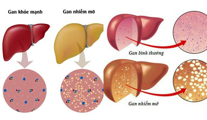 Gan nhiễm mỡ là căn bệnh bắt nguồn từ lối sống không lành mạnh, ăn uống không điều độ dễ dẫn đến gan nhiễm mỡ. Người bệnh nên đặt ra chế độ ăn uống hợp lý, hạn chế mỡ, chất cồn. Ngoài ra có thể chữa bệnh gan nhiễm mỡ bằng trà dược cũng có tác dụng rất tốt. Ảnh: Lasen.
