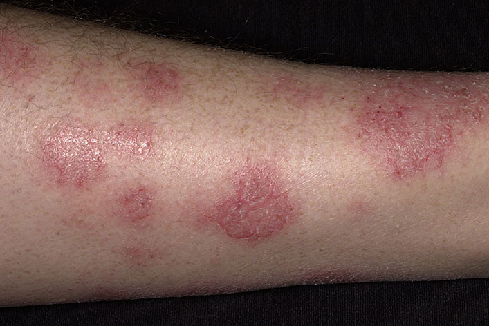 Trị eczema và ghẻ: Trộn hạt tiêu đen với bơ tươi đã diệt khuẩn làm từ sữa bò rồi bôi lên vết ngứa. Ảnh: bacsiviemdacodia.com.