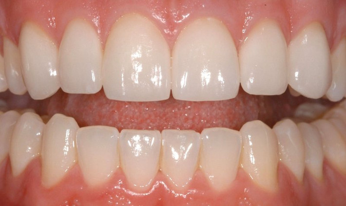 Giải quyết rắc rối về răng, lợi: Trộn một lượng tiêu bột và muối tương đương nhau. Cho thêm ít nước và dùng hỗn hợp này để mát-xa nướu. Mỗi lần dùng 1 viên như hạt vừng nhét chỗ răng sâu. Chỉ cần trộn tiêu bột với dầu đinh hương và thoa chúng lên vùng bị đau. Ảnh: LinkedIn.com. (Thông tin trong bài chỉ mang tính chất tham khảo, trước khi sử dụng bài thuốc, vui lòng hỏi ý kiến bác sĩ).