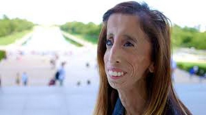 Lizzie Velasquez, sống tại thành phố Austin, bang Texas, Mỹ là một trong ba người trên thế giới sinh ra mắc căn bệnh di truyền hiếm gặp khiến cô không thể tăng cân. Ngay từ nhỏ, cô đã rất gầy. Cho dù duy trì thực đơn 60 bữa nhỏ/ngày, Lizzie cũng không thể nào cải thiện cân nặng của mình. Ảnh: Today.
