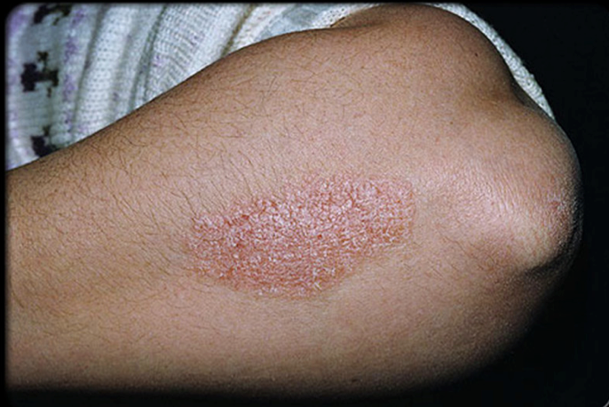 10. Chữa trị bệnh ngoài da như bệnh vẩy nến, eczema và bệnh ung thư thậm chí nước tiểu là mát xa trên da. Ảnh: chuyenkhoadalieu.net.