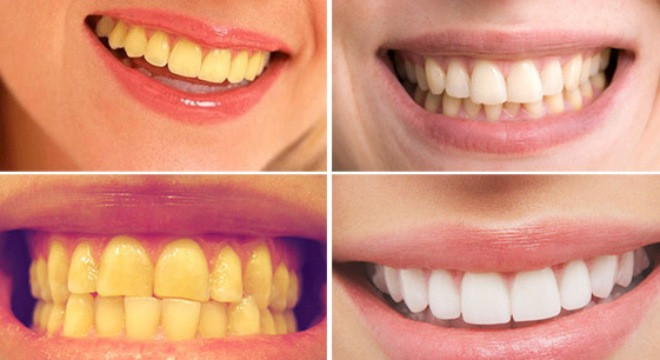 6. Tẩy trắng răng: Thời La Mã cổ đại, người dân sử dụng nước tiểu nhằm tẩy trắng răng, dựa vào việc ammoniac - thành phần chính có trong nước tiểu - là một chất tẩy khá mạnh. Ảnh: thuockidieu.com.